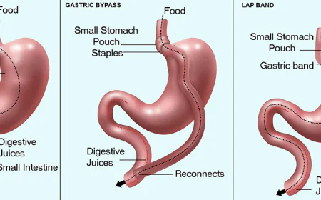 How Bariatric Surgery Helps Manage Obesity and Related Health Conditions