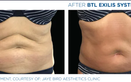Skin Tightening Treatments for Firmer and Younger-Looking Skin