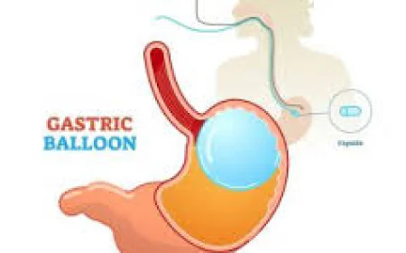 Understanding the Benefits of Gastric Balloon in Dubai for Effective Weight Loss