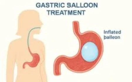 MedCell Laparoscopic Balloon in Dubai: Benefits for Effective Weight Management