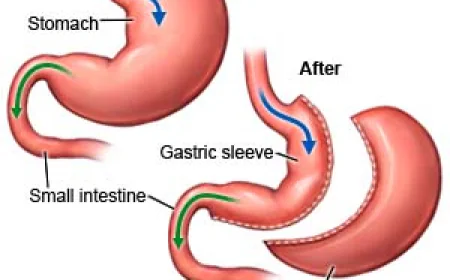 Laparoscopic Sleeve Gastrectomy in Dubai – Safe and Effective Weight Loss Solution