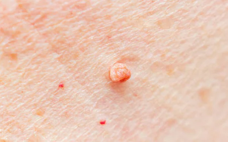 Can Skin Tag Removal Improve Skin Appearance Fast