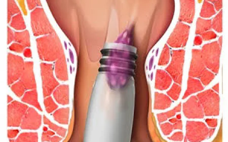 Understanding Non-Surgical Hemorrhoid Treatment in Dubai Options