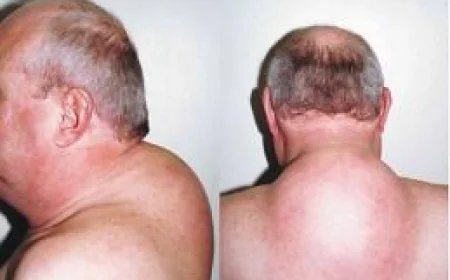 Buffalo Hump Removal in Dubai for Improved Neck Contours | Complete Guide