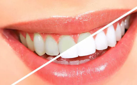 Teeth Whitening Dubai Benefits Beyond Appearance