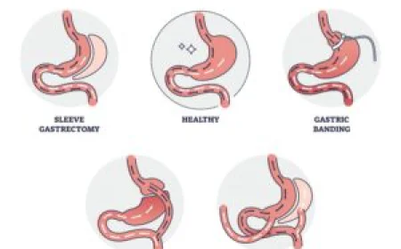 Understanding How Gastric Bypass in Dubai Helps Transform Lives