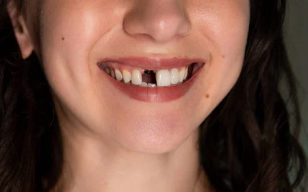 In Pakistan Tooth Fracture Treatment  Early Care Can Save Your Natural Smile:
