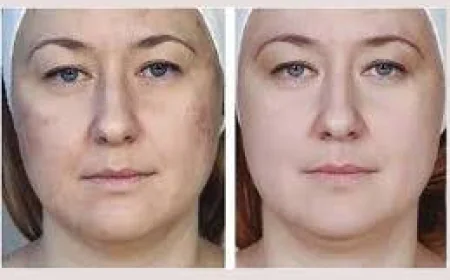 Understanding the Benefits of Mesotherapy for Bikini Area in Dubai