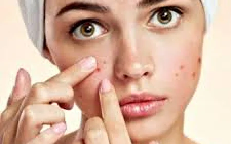 Acne Removal in Dubai: Treatments and Strategies for Long-Term Skin Clarity