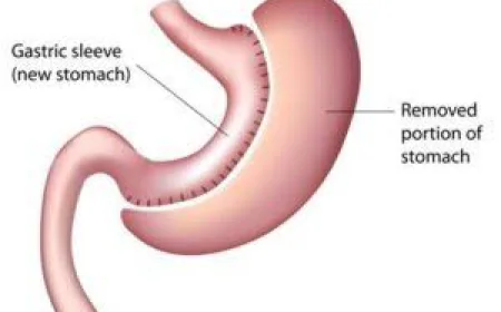 Laparoscopic Sleeve Gastrectomy in Dubai – A Complete Guide to Safe and Effective Weight Loss