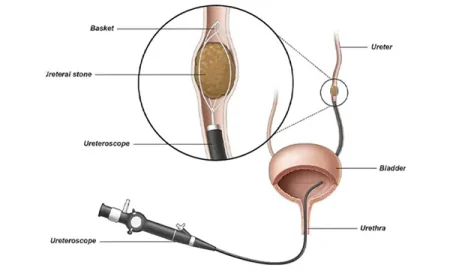 Laser URSL Surgery in Gurgaon