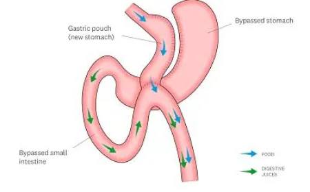 Your Complete Guide to Gastric Bypass in Dubai