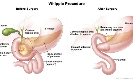 Whipple Surgery in India: Advanced Surgical Treatment for Pancreatic Cancer
