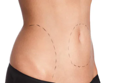 How Painful Is a Body Lift During Healing