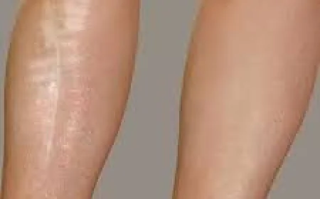 Leg Laser in Dubai | Complete Guide to Long-Lasting Hair Reduction