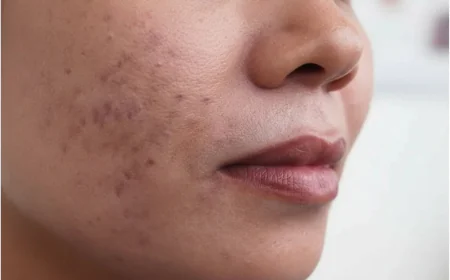 Can Erbium Peeling Reduce the Appearance of Dark Spots?