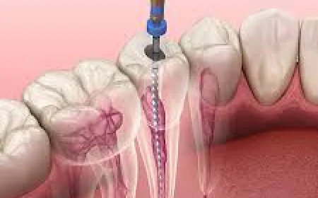 Understanding Root Canal Treatment in Dubai: Symptoms and Solutions