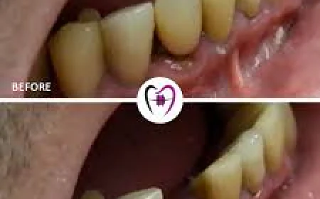 Emergency Tooth Removal in Fitchburg MA | Trusted Dentist at Whalom Dental