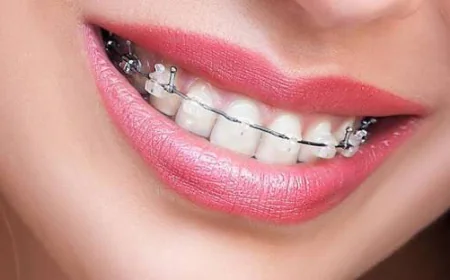 Braces for Adults Benefits and Treatment Options