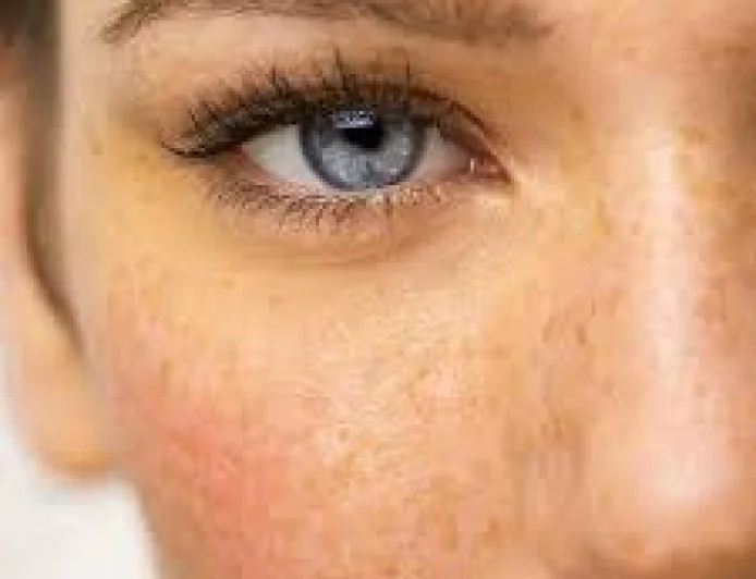 Best Benefits of Skin Pigmentation Treatment in Dubai