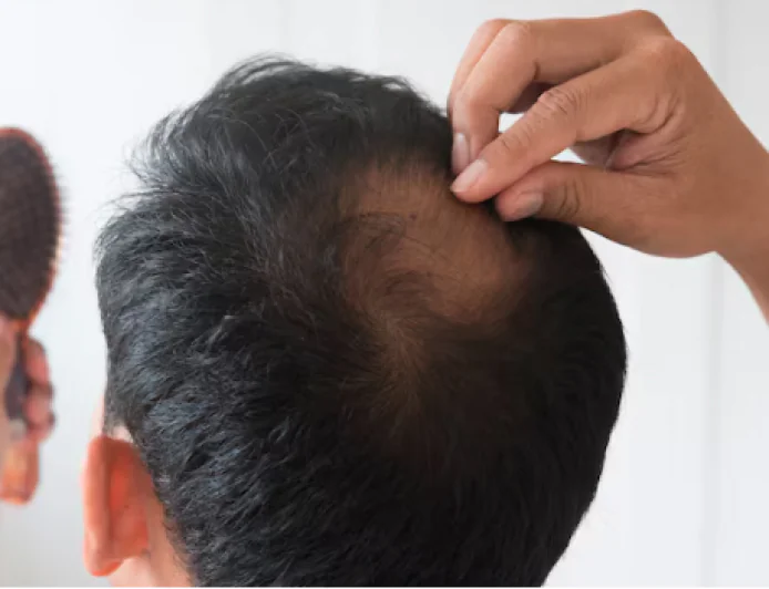 Effective Hair Loss Treatment in Beverly Hills, CA: Your Guide to Restoring Confidence