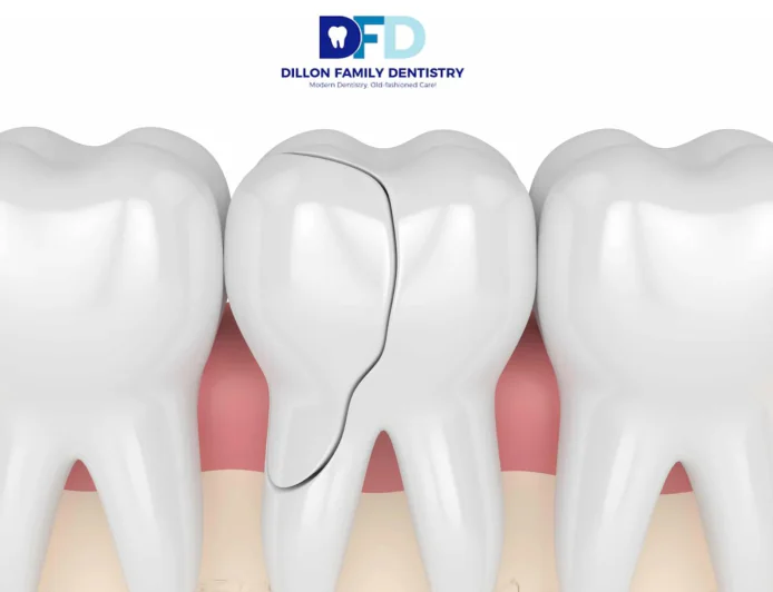 Cracked Tooth Emergency? What To Do | Dentist Bryn Mawr