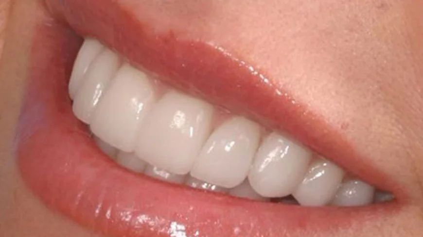 Veneers Dubai: Benefits, Costs, and Treatment Options