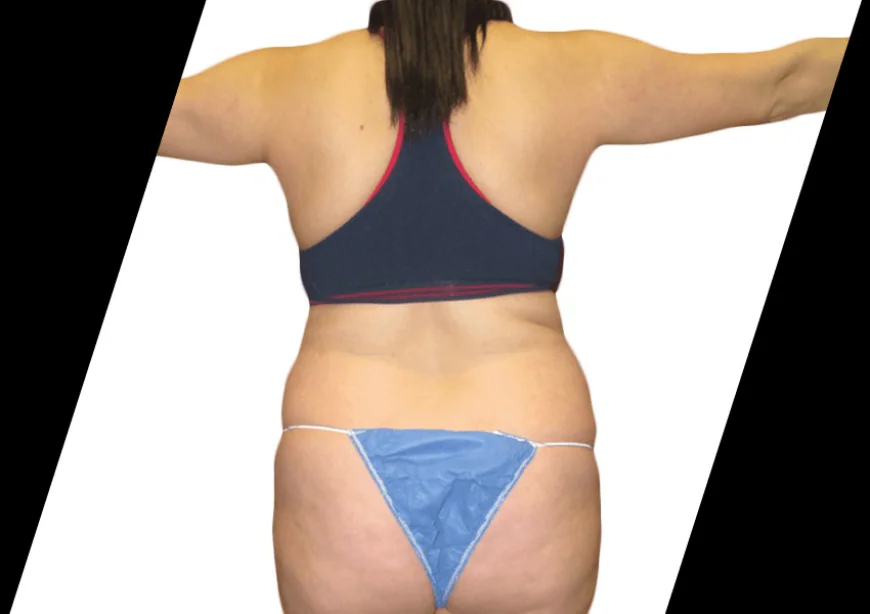 Why Should You Choose Smart Lipo Laser Houston for Fat Reduction?