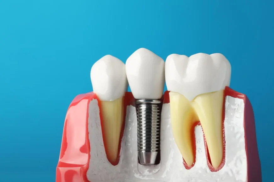 Missing Teeth? Here's Why Dental Implants Could Be the Perfect Solution
