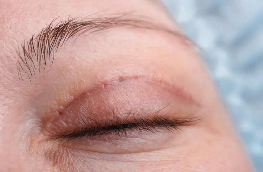 What Blepharoplasty Means for Upper Eyelid Anatomy