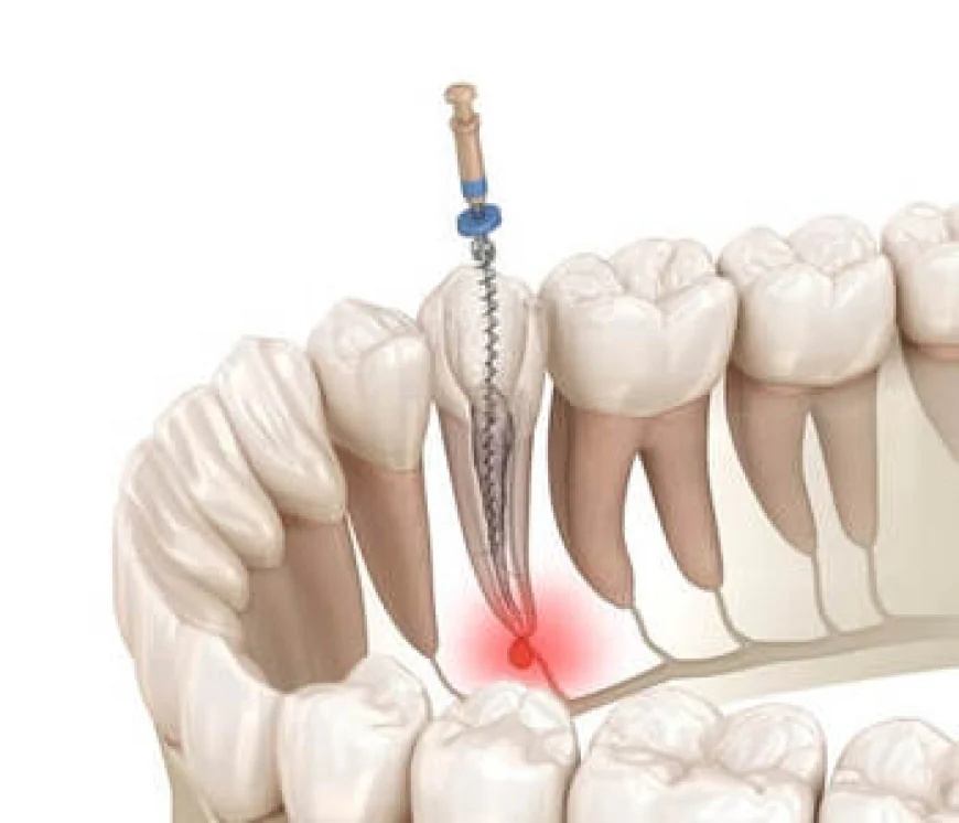 A Complete Guide to Root Canal Treatment