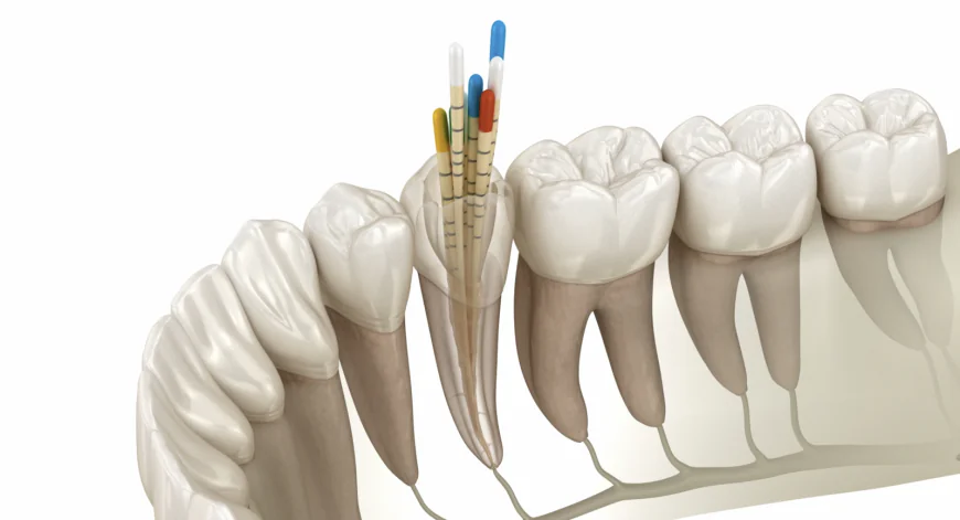 Understanding Root Canal Treatment: Signs, Treatment and Long-Term Care