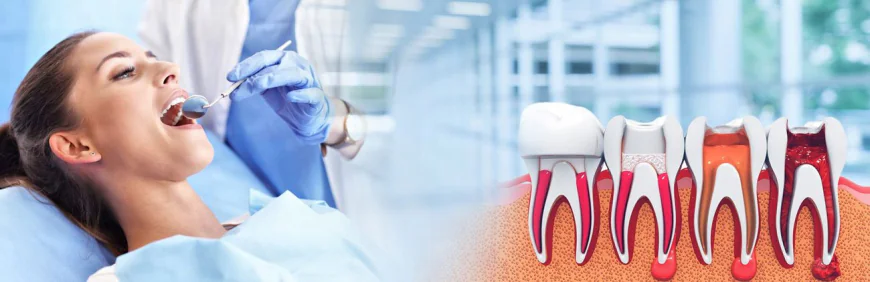 Save Your Tooth: Everything You Need to Know About Root Canal Treatment