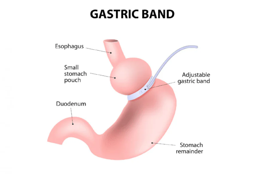 How to Choose the Right Surgeon for Gastric Banding