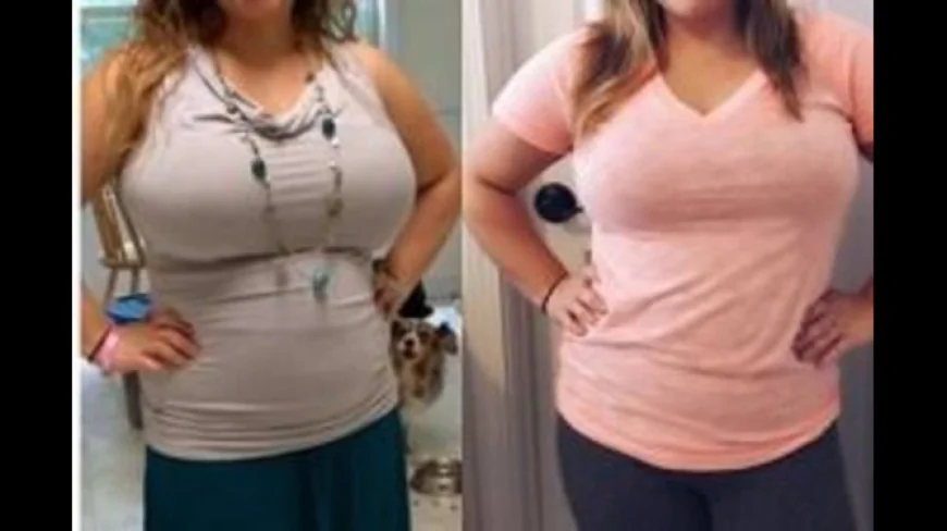 Body Lift in Dubai: Procedure, Benefits, Recovery, and Full Body Contouring Guide