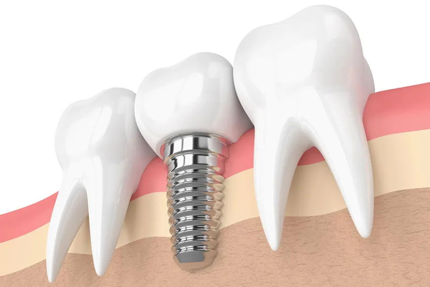 Before Comparing Dental Implant Quotes, Read This