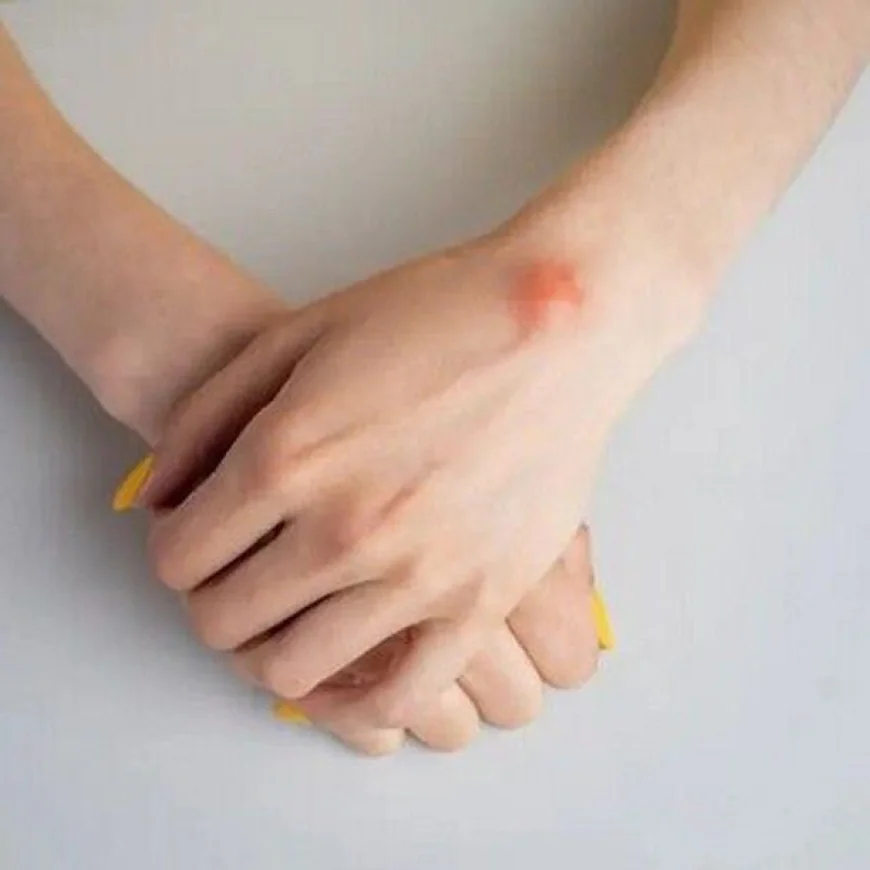 Lipoma Treatment in Dubai: Addressing Persistent Lumps
