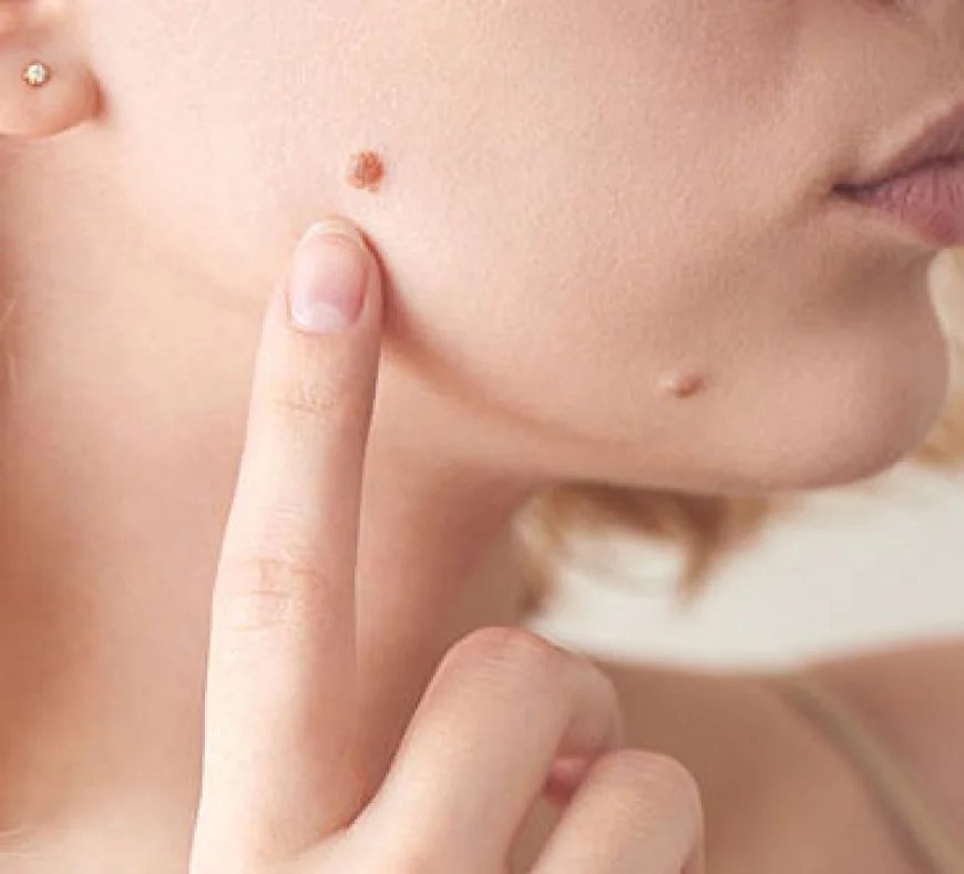 How Effective Is Mole Removal for Facial Moles?