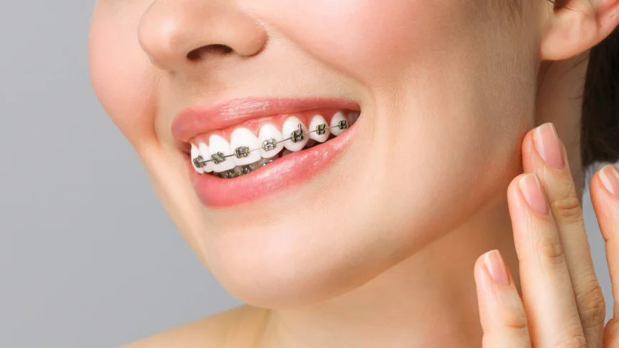 Why Metal Braces Dubai Remain a Popular Choice