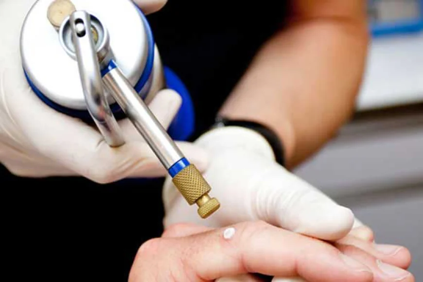 Can Cryosurgery Be Used to Treat Skin Lesions?