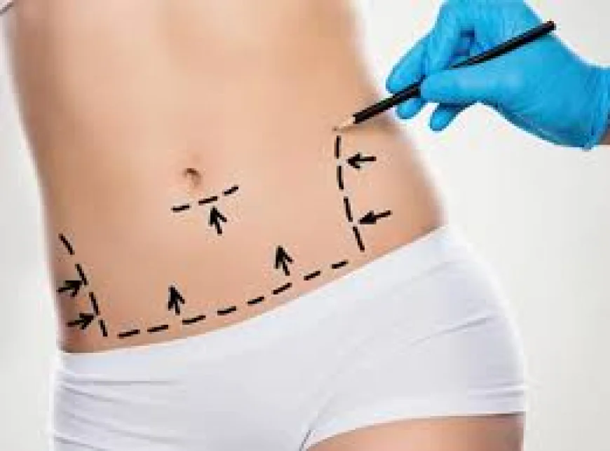 Liposuction in Islamabad – Achieve a Slimmer, More Sculpted Body
