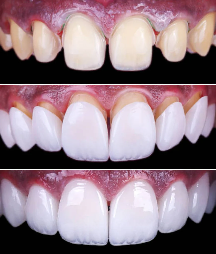 Why More People Are Choosing Dental Veneers for a Perfect Smile in Pakistan
