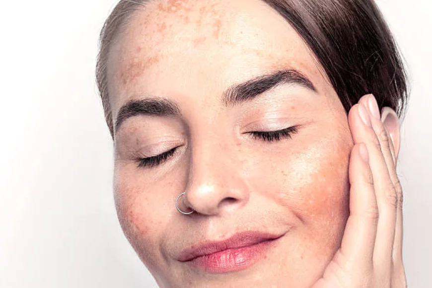 How Does Melasma Treatment Reduce Dark Facial Patches