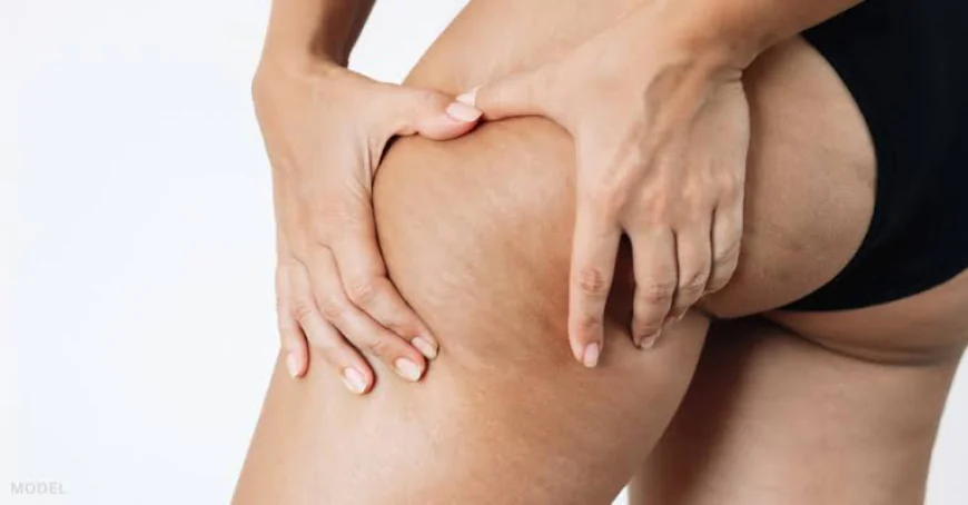 Why Is Cellulite Treatment Worth Considering?