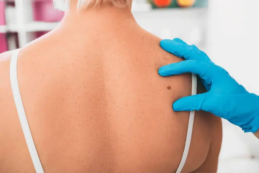 Who Is a Good Candidate for Mole Removal?