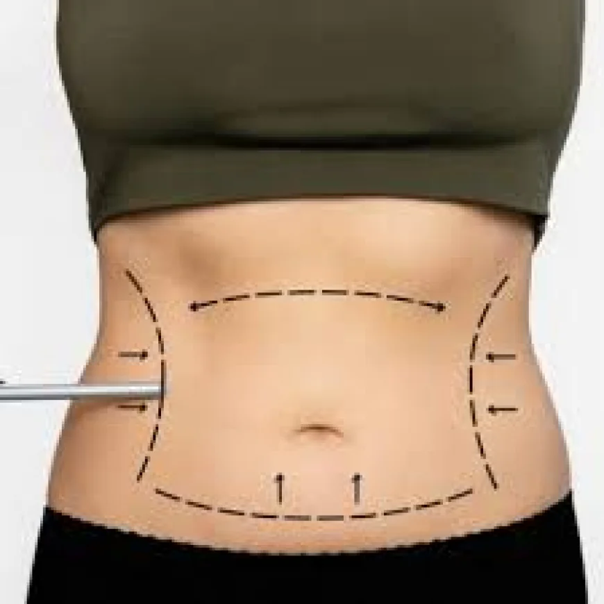 Everything You Need to Know About Liposuction Surgery in Dubai