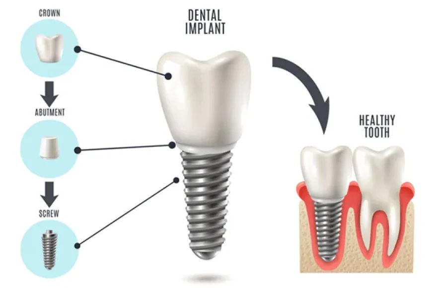 Dental Implants: A Long-Term Solution to Restore Oral Health and Confidence