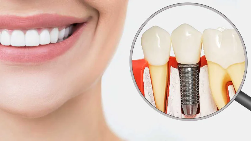 My Life After Teeth Replacement – A Complete Smile Transformation Story