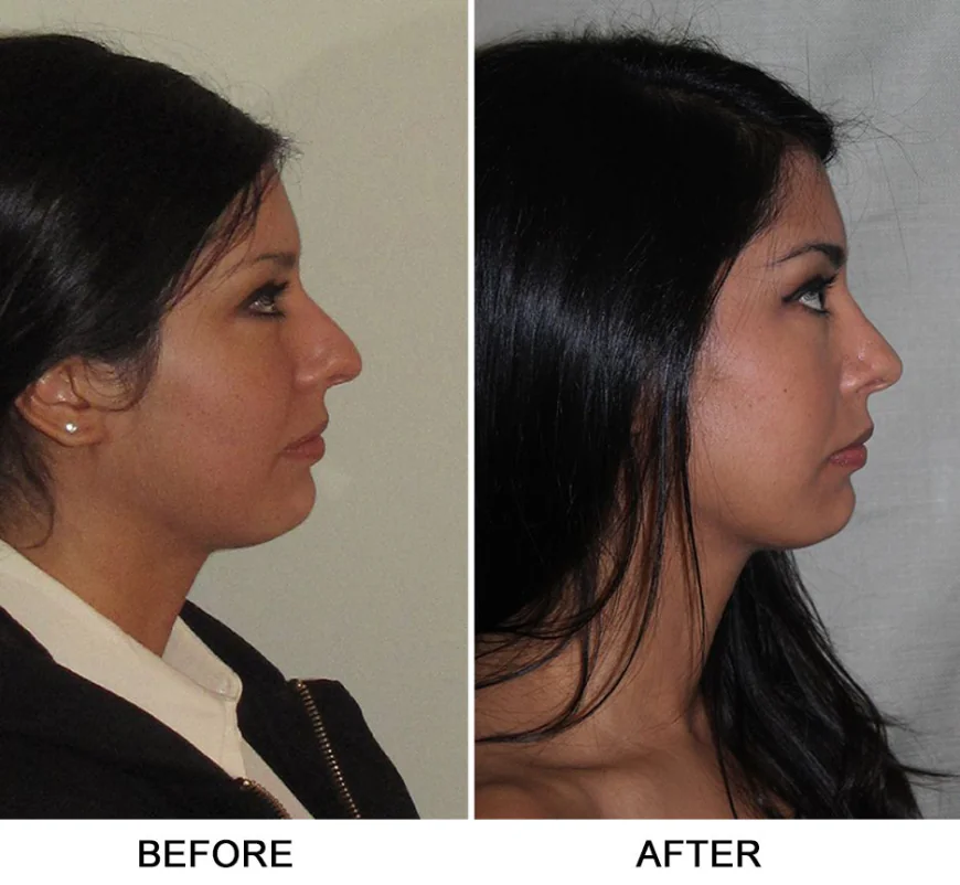 Septoplasty and Turbinate Reduction in Dubai: Breathe Better
