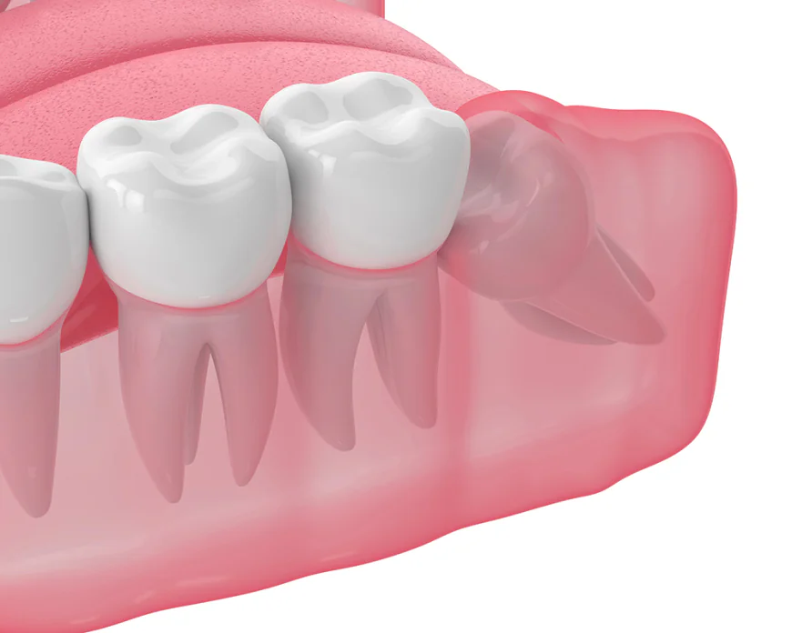 Why Delaying Tooth Removal Can Affect Your Oral Health